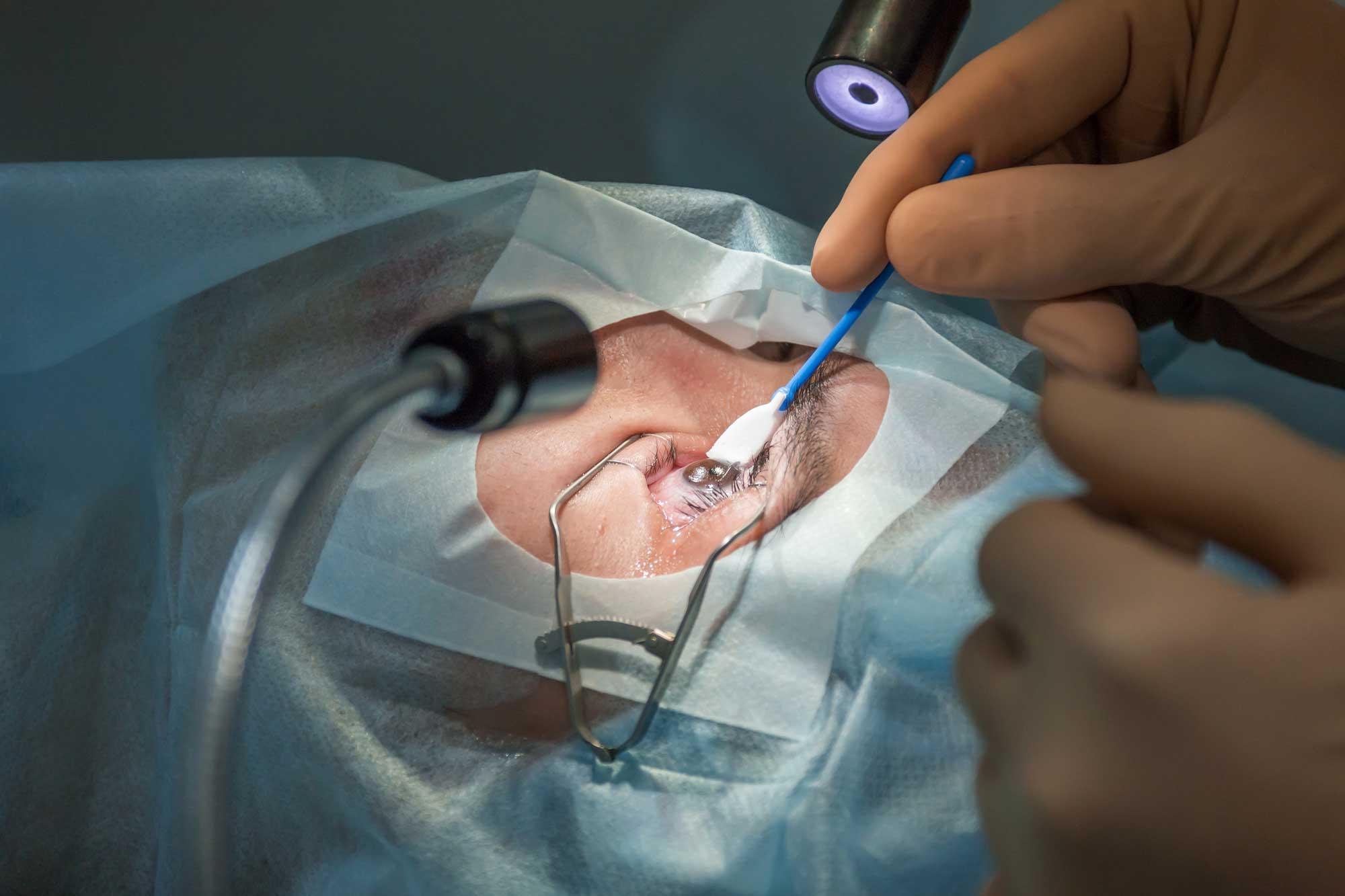 Discover How LASIK Surgery Reshapes Your Eyes for Sharper Vision and Lasting Clarity