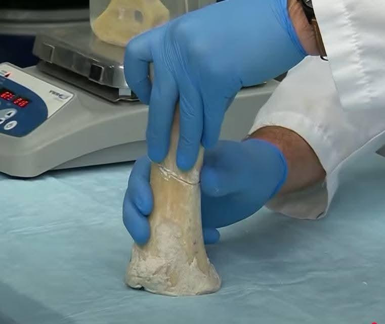 A Simple Glue Could End the Era of Metal Plates in Bone Repair