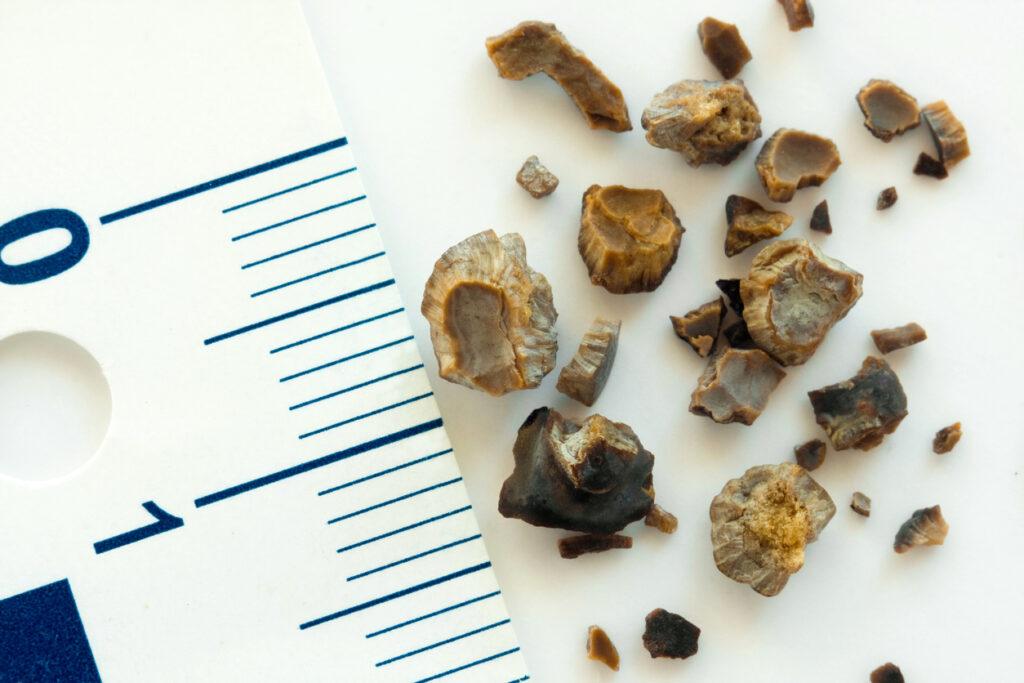 The Silent Warning Signs Your Kidneys Are Struggling Before a Stone Forms