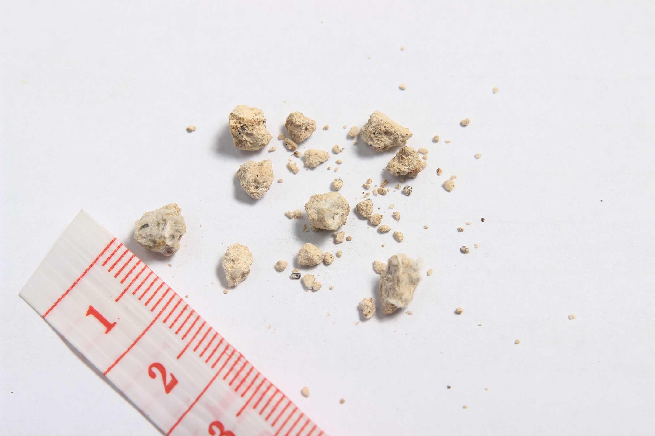 The Pain That Feels Like Fire Starting Deep in Your Lower Back Could Be Kidney Stones