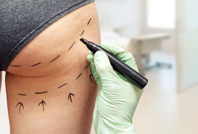 Why BBL Surgery Has Become the Most Talked About Body Procedure Today